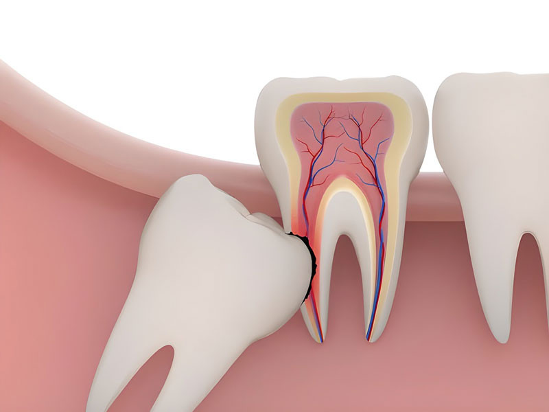 Nhổ răng khôn giúp làm nhỏ mặt? phương pháp nhổ răng khôn tốt nhất 2024 là gì?